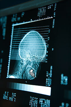 Scan of Alzheimer's patient